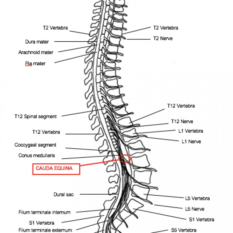 What is Cauda Equina?